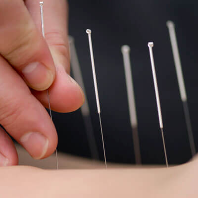Acupuncture needles in a person's skin